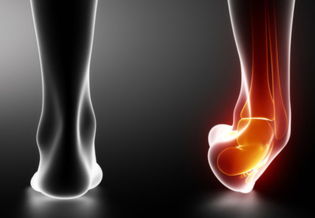 Distorsione della caviglia: cos'è e come si tratta