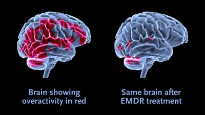 EMDR, desensibilizzazione e rielaborazione attraverso i movimenti oculari