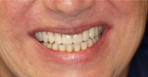 Sorriso prima e dopo All on Four