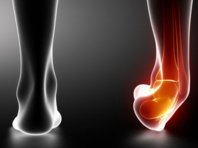 Distorsione della caviglia: cos'è e come si tratta