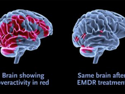 EMDR, desensibilizzazione e rielaborazione attraverso i movimenti oculari